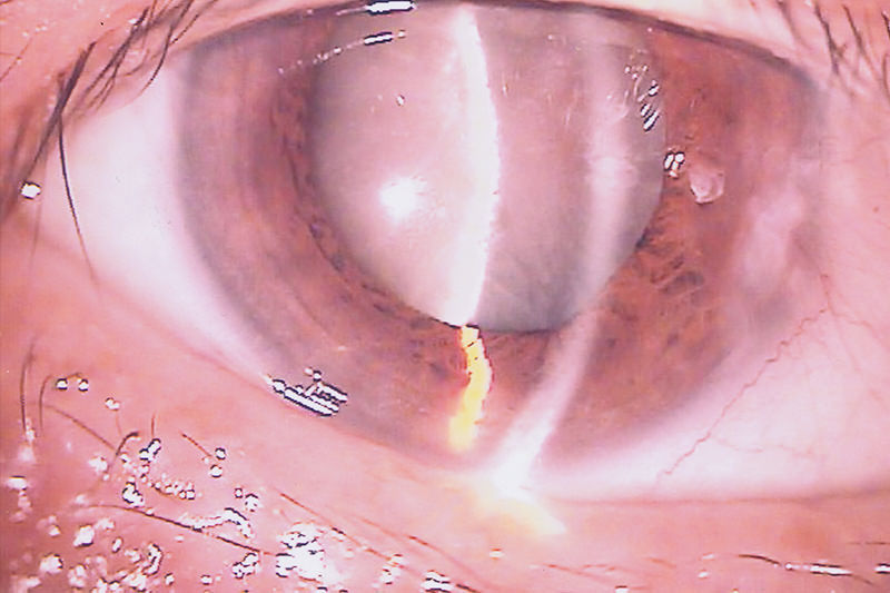 眼球の中でレンズの役割をする「水晶体」が、何らかの原因で濁る病気です。