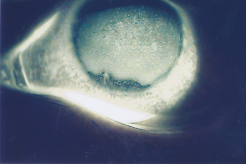黒目の表面の角膜に炎症が起こった状態の総称です。