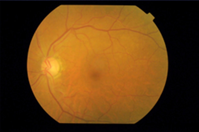 高血圧性網膜症の危険因子